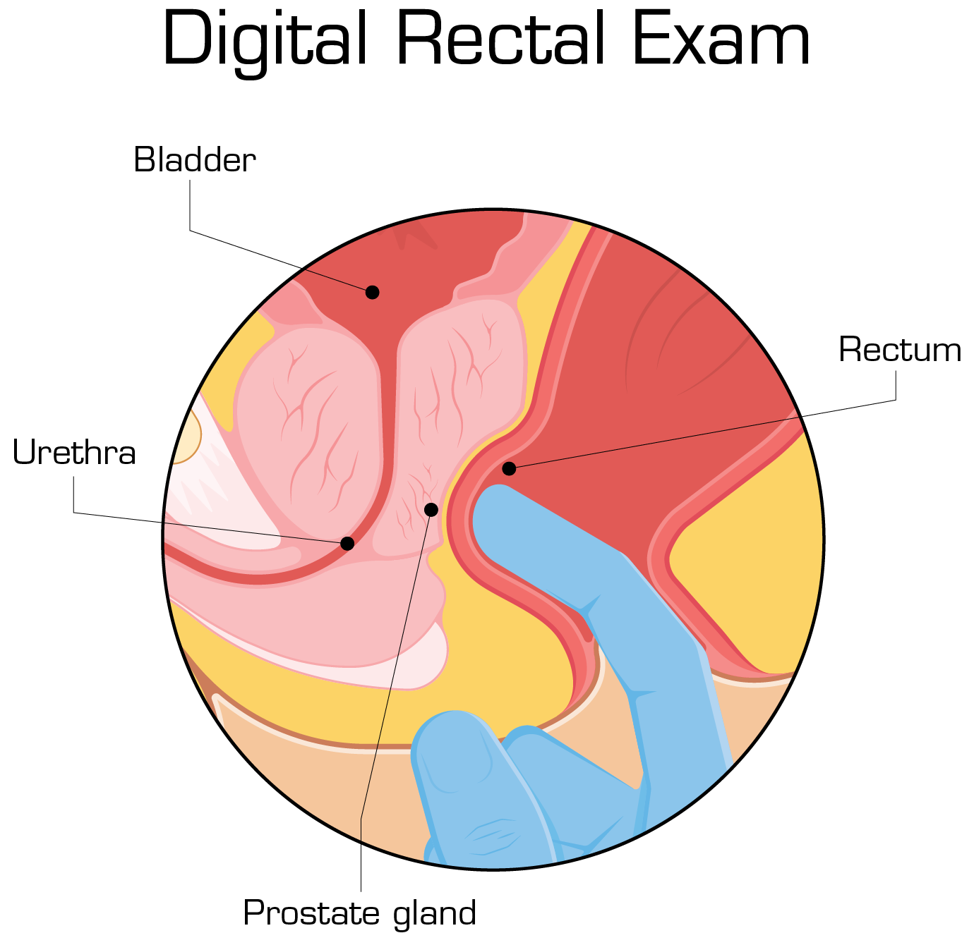 benign-prostatic-hyperplasia-bph-surgery-ems-urology